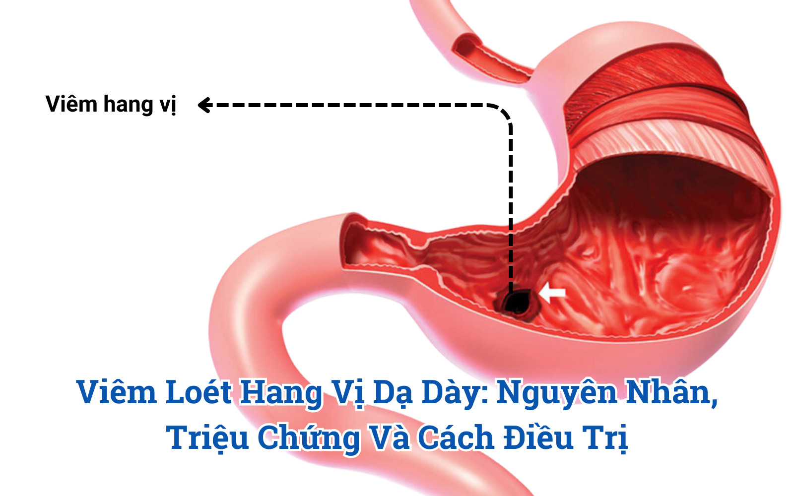 Viêm Loét Hang Vị Dạ Dày: Nguyên Nhân, Triệu Chứng Và Cách Điều Trị