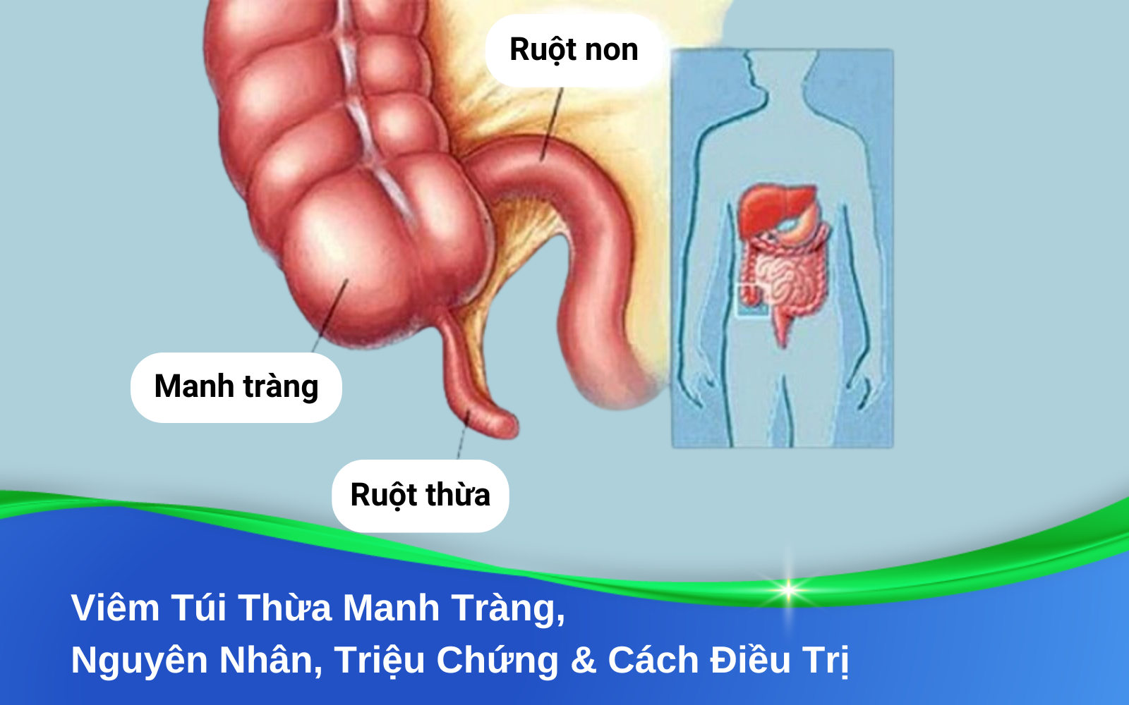 Viêm Túi Thừa Manh Tràng, Nguyên Nhân, Triệu Chứng & Cách Điều Trị