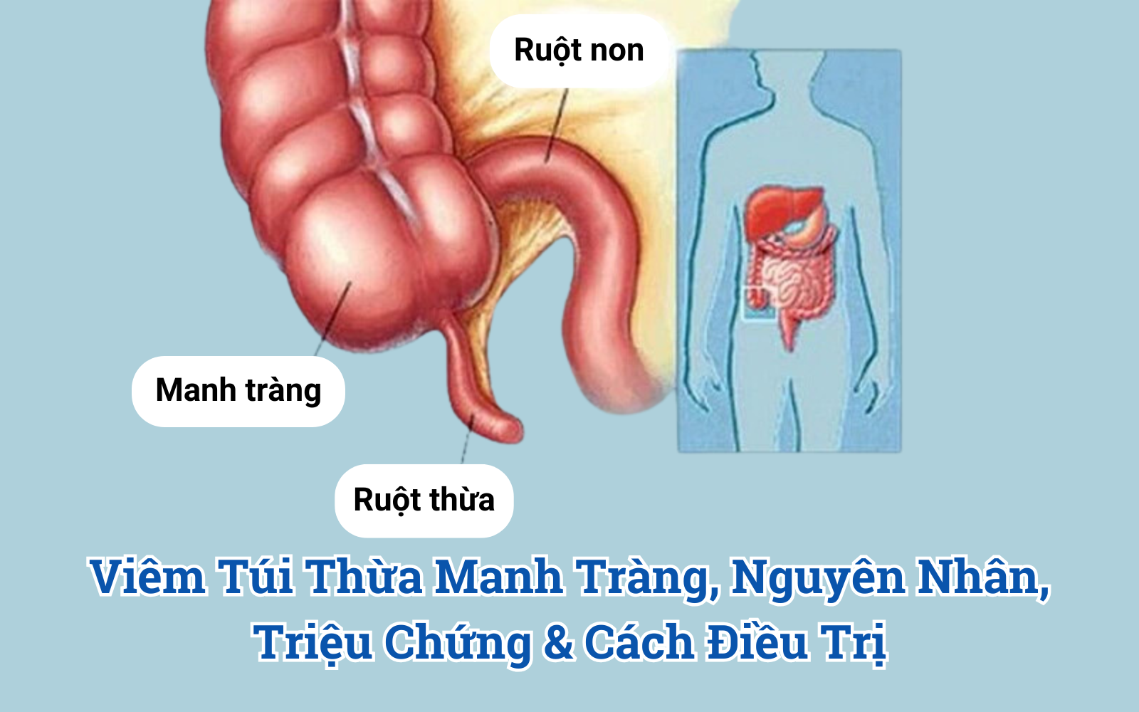Viêm Túi Thừa Manh Tràng, Nguyên Nhân, Triệu Chứng & Cách Điều Trị