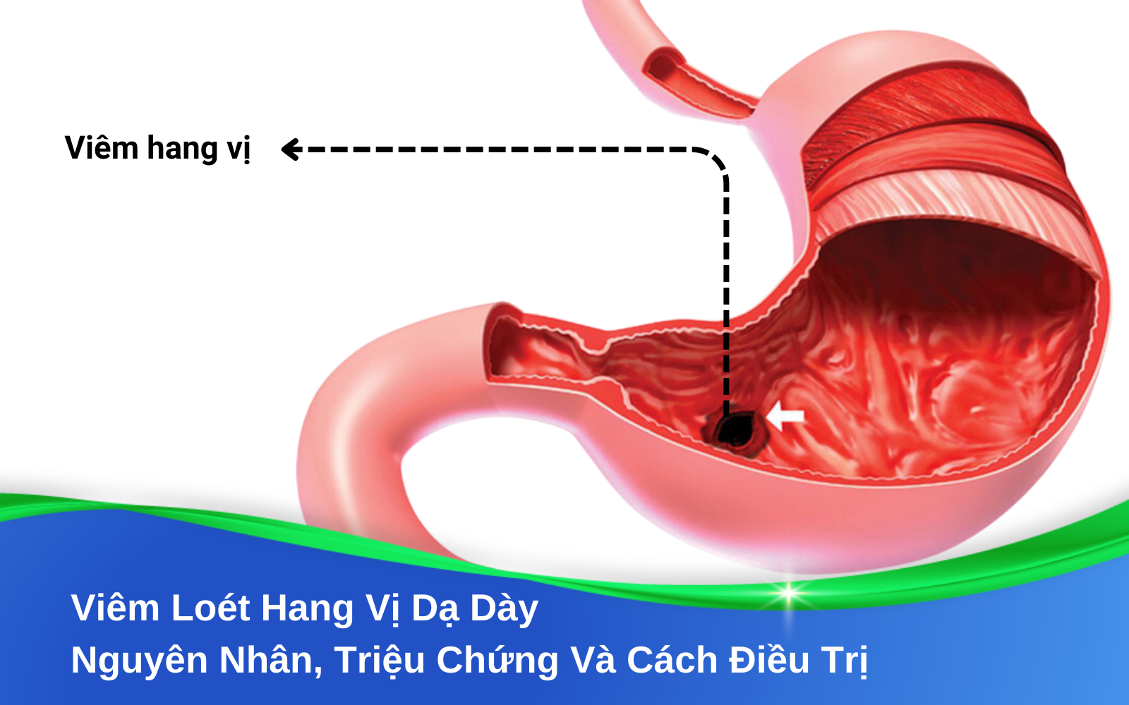 Viêm Loét Hang Vị Dạ Dày: Nguyên Nhân, Triệu Chứng Và Cách Điều Trị