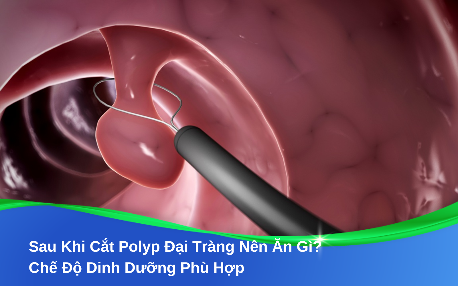 Sau Khi Cắt Polyp Đại Tràng Nên Ăn Gì? Chế Độ Dinh Dưỡng Phù Hợp