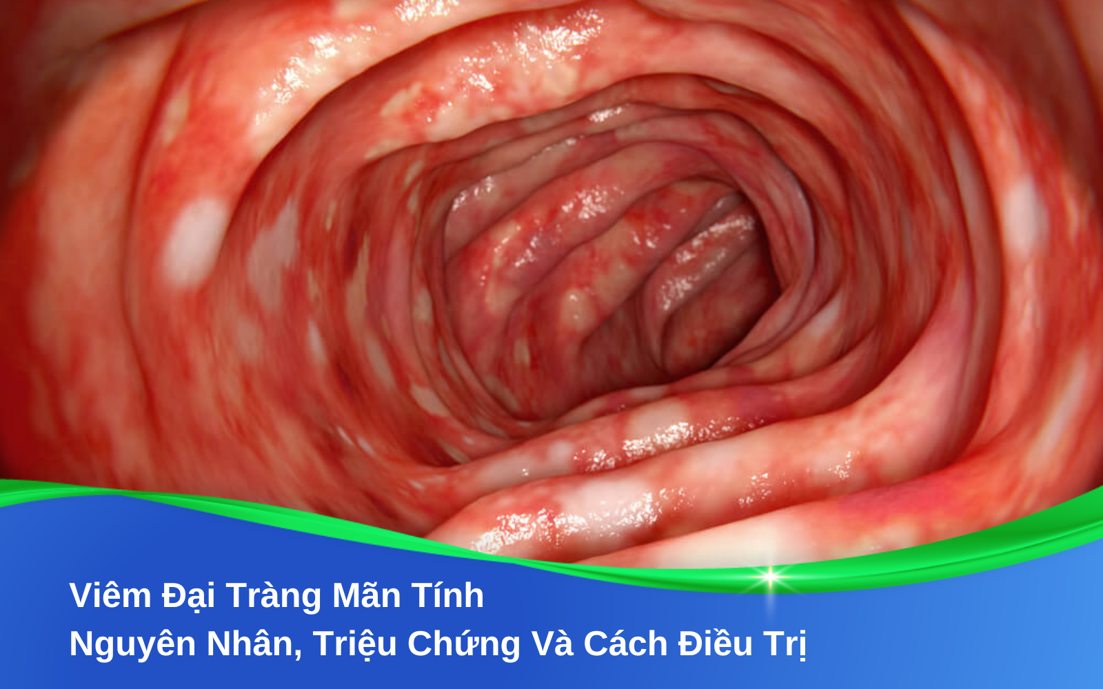 Viêm Đại Tràng Mãn Tính: Nguyên Nhân, Triệu Chứng Và Cách Điều Trị