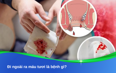 Đi ngoài ra máu tươi là bệnh gì? Dấu hiệu cảnh báo không nên bỏ qua