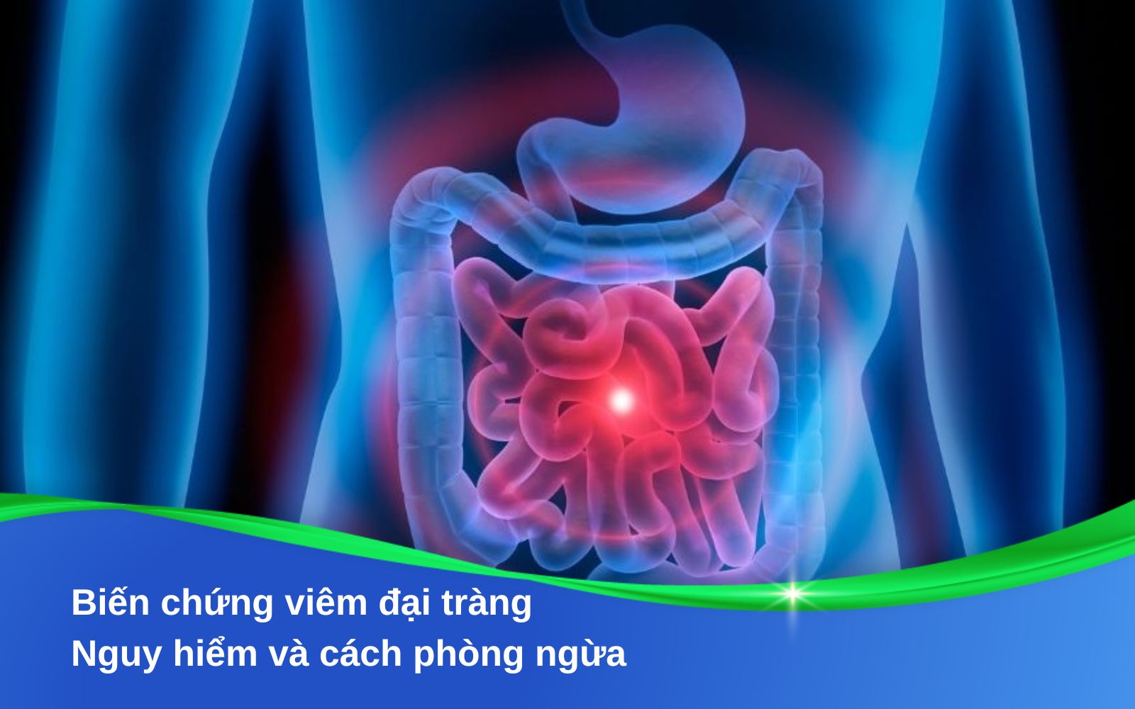 Biến chứng viêm đại tràng Nguy hiểm và cách phòng ngừa