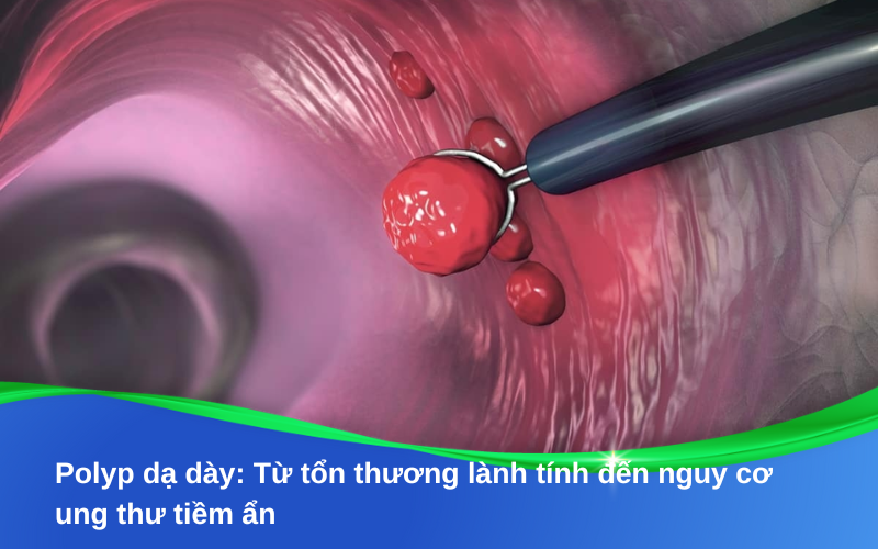 Polyp dạ dày: Từ tổn thương lành tính đến nguy cơ tiềm ẩn cần cảnh giác