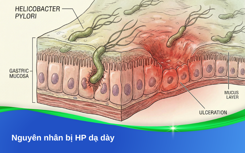 Nguyên nhân bị HP dạ dày: những điều người đọc cần biết để phòng và điều trị hiệu quả